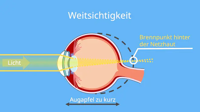 Sammellinse, Sammellinsen, Physik Sammellinse, Weitsichtigkeit Sammellinse