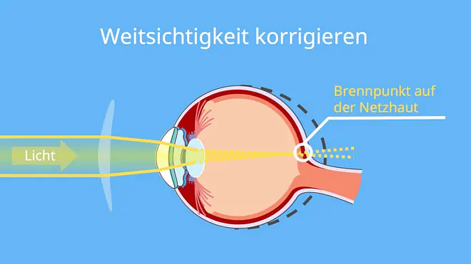 Sammellinse, Sammellinsen, Physik Sammellinse, Weitsichtigkeit Sammellinse