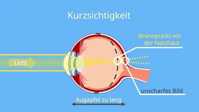 Zerstreuungslinse, Streulinse, Zerstreuungslinse Bild, Was ist eine Linse, Kurzsichtigkeit Zerstreuungslinse