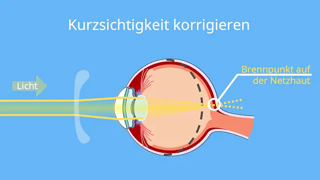 Zerstreuungslinse, Streulinse, Zerstreuungslinse Bild, Was ist eine Linse, Kurzsichtigkeit Zerstreuungslinse